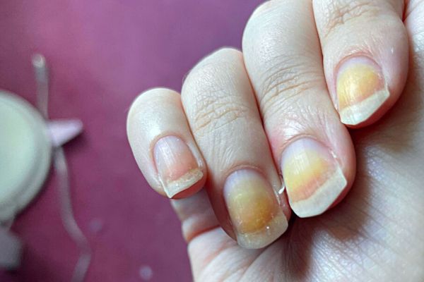 Ongle Jaune Quels Causes Et Traitements Efficaces