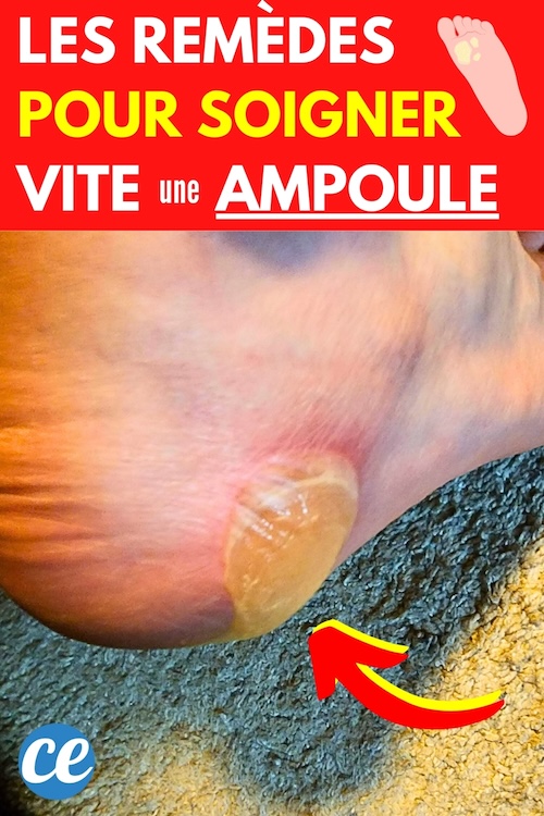 Ampoule au Pied Les Meilleurs Remèdes de Grand Mère Pour la Soigner Vite