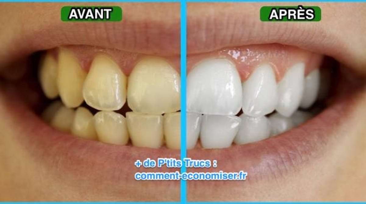 Une Astuce Étonnante Pour Avoir les Dents Blanches Naturellement