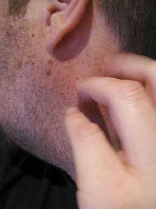 piqûre de moustique soulager vinaigre blanc