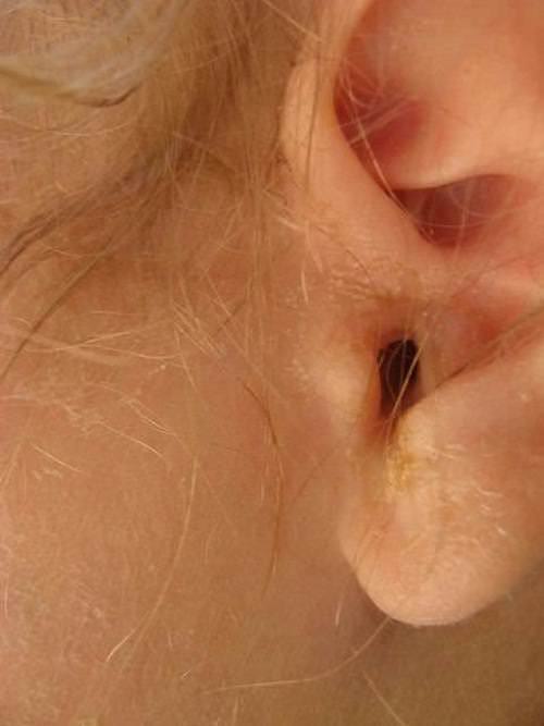 infection oreille remède naturel