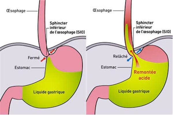 éviter reflux acide vinaigre de cidre