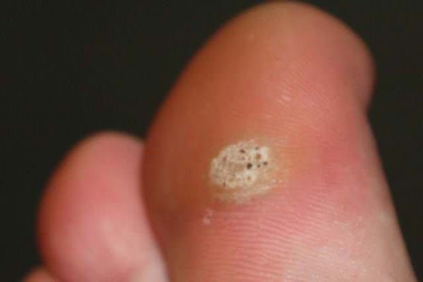 verrues plantaires remède naturel