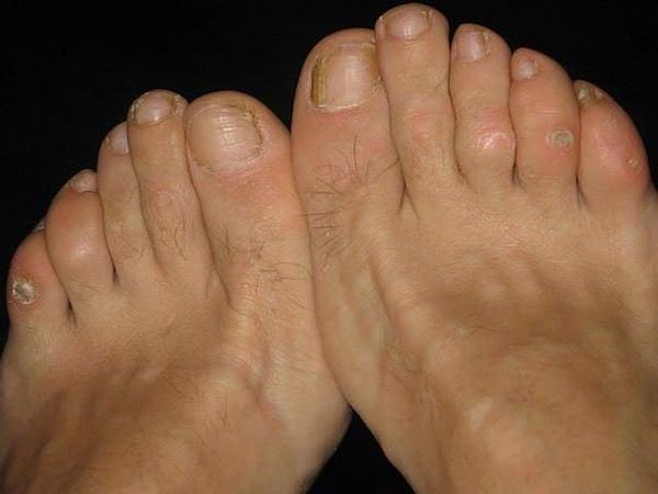 cors des pieds remède naturel