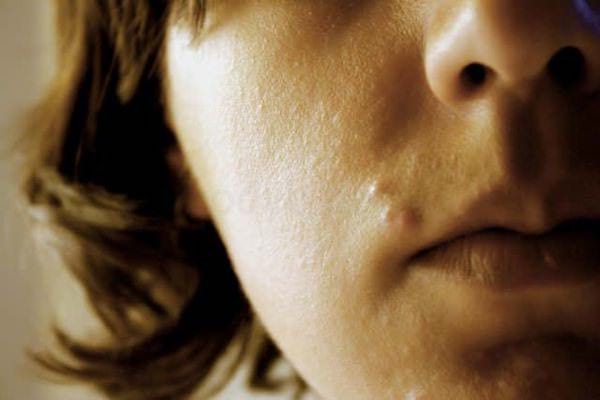 acné visage remède naturel