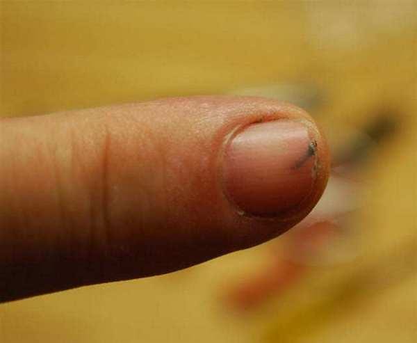 écharde dans le doigt remède naturel