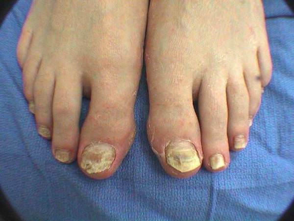 mycose ongles pieds soigner vinaigre