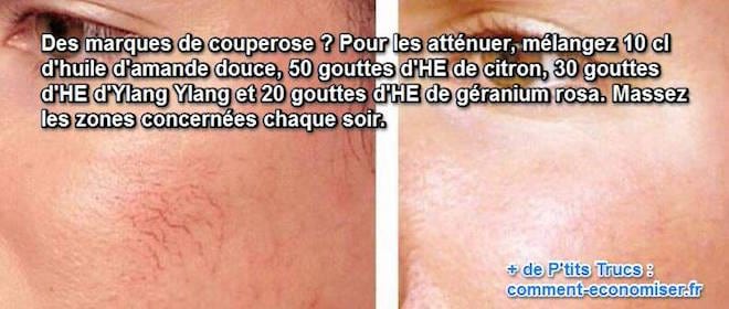 soigner la couperose au naturel soigner la couperose au naturel