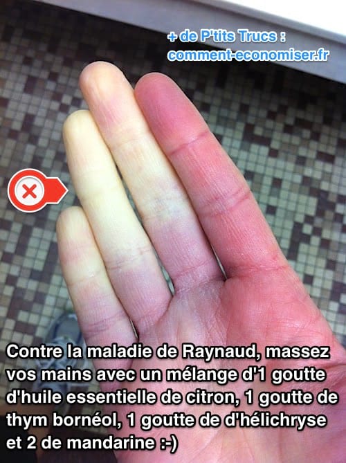 Remèdes aux huiles essentielles contre la maladie de Raynaud