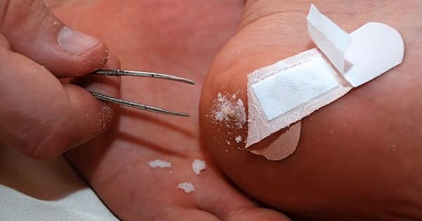 le sel d'epsom permet de faire remonter une écharde