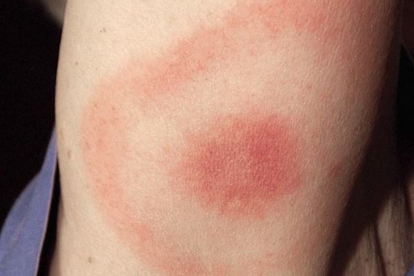 La marque rouge autour d'une piqûre de tique indique souvent que la maladie de lyme a été cotnractée