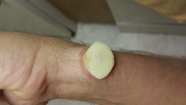 l'ail peut irriter la peau à cause de ses principes actifs. Il faut donc la protéger avec de l'huile végétale