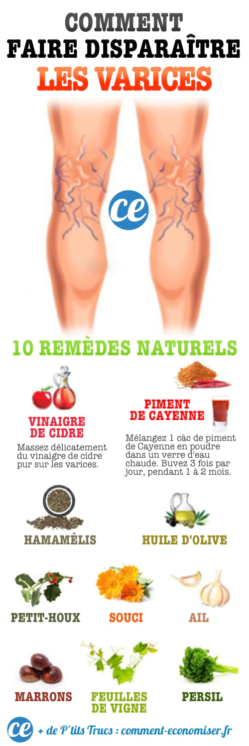 varices jambes que faire