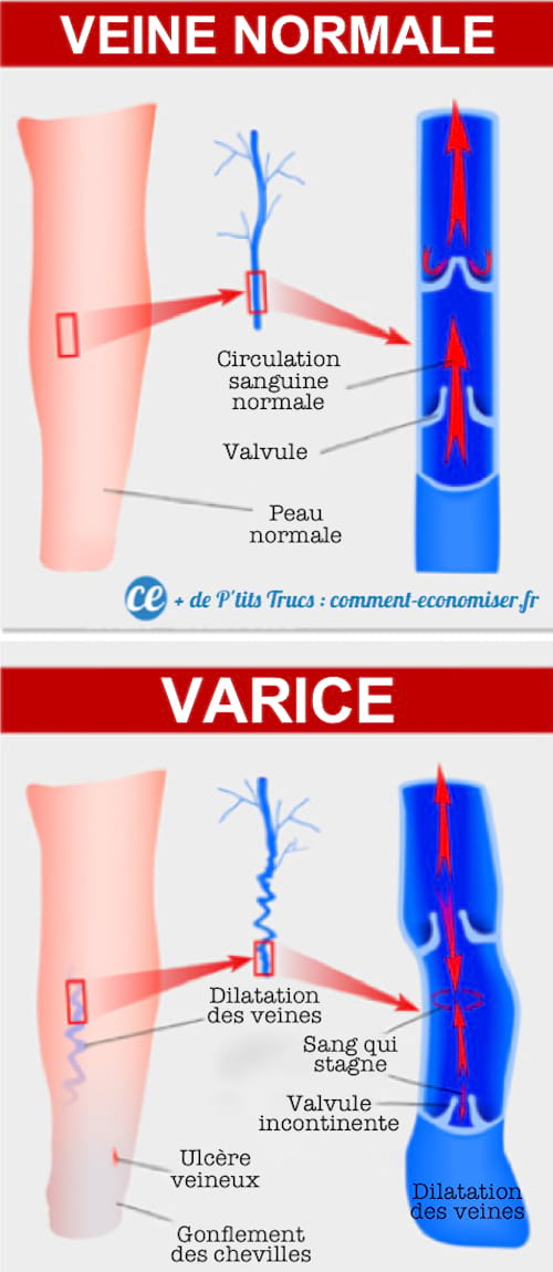 Comparaison des veines normales et des varices