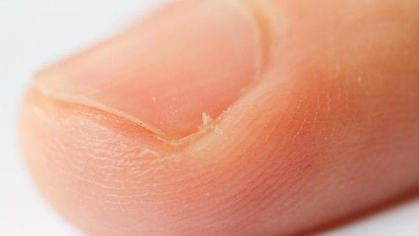 Un doigt avec des envies ou petites peaux.