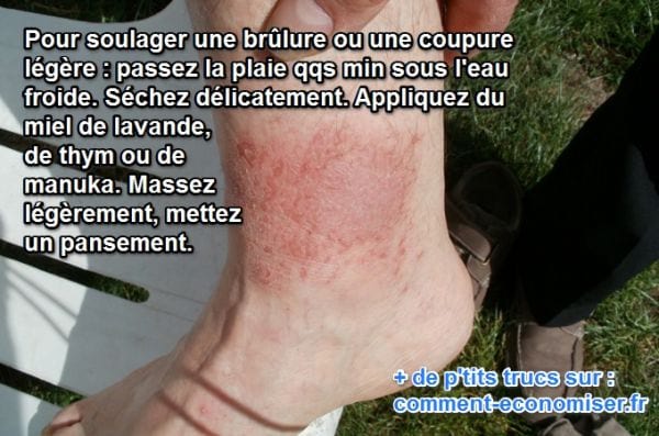 appliquer du miel sur une brulure l'apaise