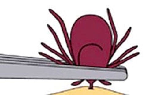 tirer la tique avec la pince à épiler