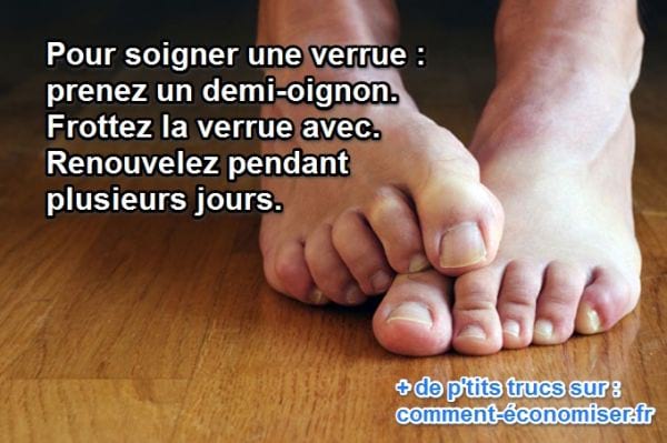 frotter une verrue avec un oignon la soigne.