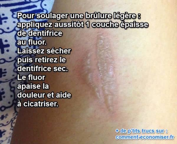 le dentifrice au fluor soulage les brulures légères
