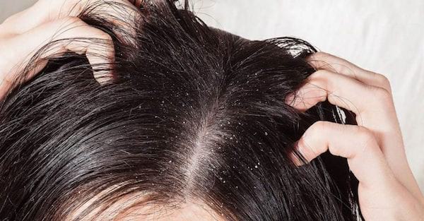 l'huile essentielle de lavande permet de se débarrasser des pellicules