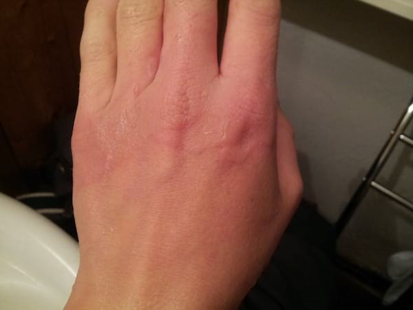 l'huile essentielle de lavande soigne les petites brûlures