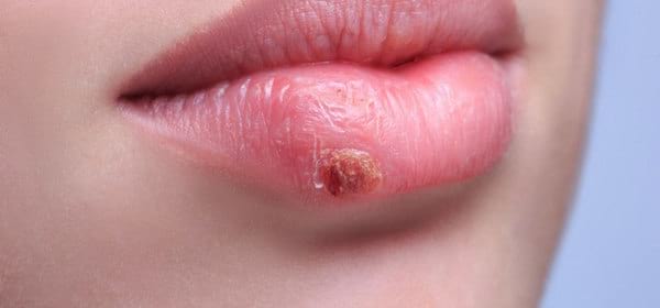 l'huile essentielle de lavande soigne les boutons de fièvre