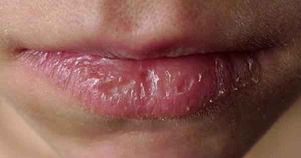 protéger les lèvres gercées avec de l'huile essentielle de lavande