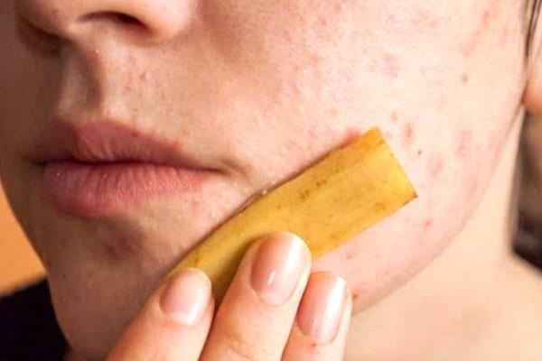 peau de banane pour soigner acné
