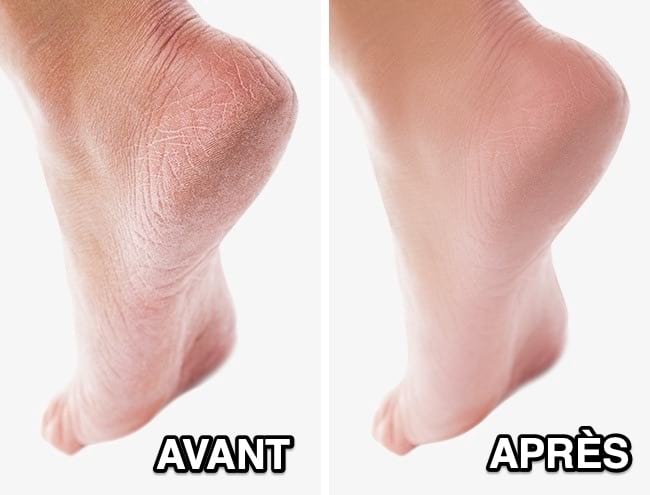 Des pieds secs et craquelés à gauche et des pieds avec une peau douce à droite