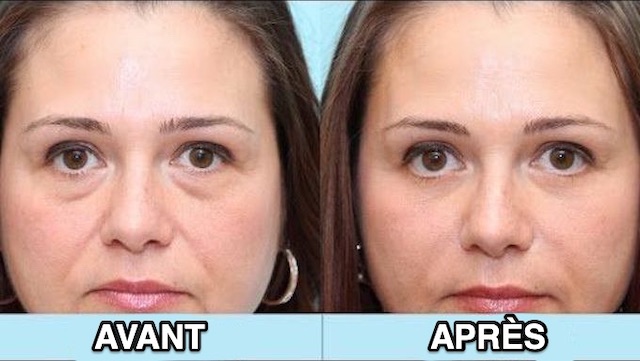 L'Astuce Miracle Contre Les Yeux Gonflés Au Réveil.