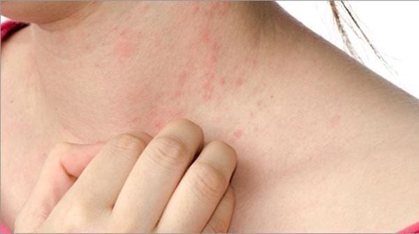 Des boutons d'eczéma dans le cou