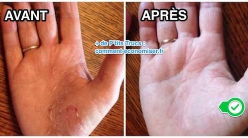 Une main avec du psoriasis et une main sans psoriasis après traitement