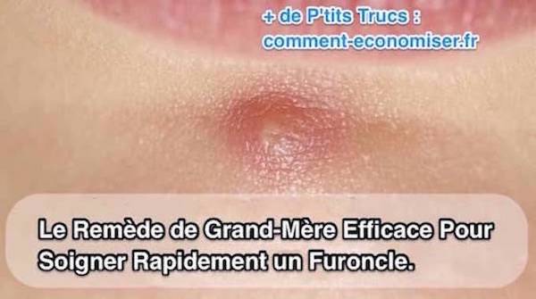Un rimedio per curare l'ebollizione