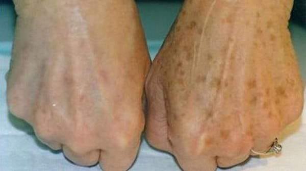 Une main avec des taches de vieillesse et une main sans tache de vieillesse