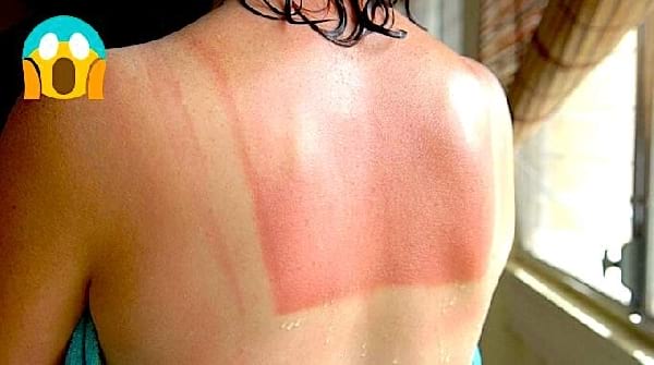 Coup de Soleil : Le Remède Magique Au Bicarbonate !