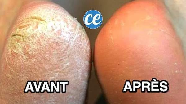 Des pieds secs et abîmés avant et après un soin maison