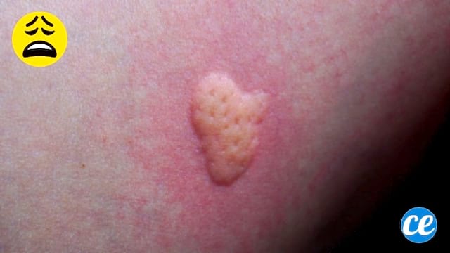 Une grosse piqûre de moustique qui gratte