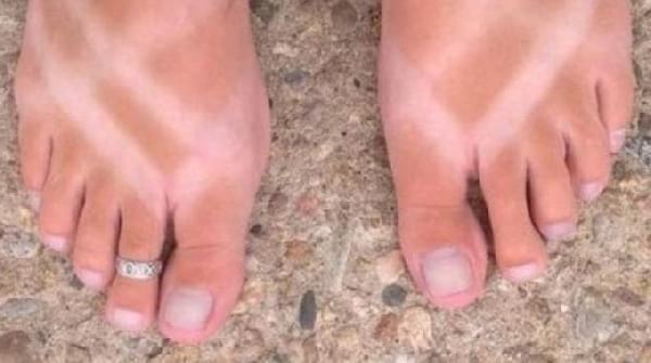 remede-contre-les-coups-soleil