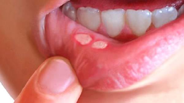 Pour soigner facilement un aphte