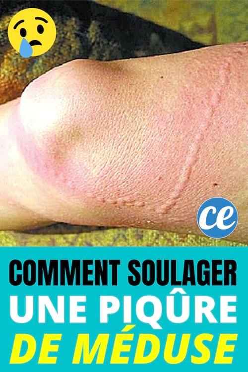 Piqûres de Méduse : Voici Comment Stopper la Douleur IMMÉDIATEMENT !