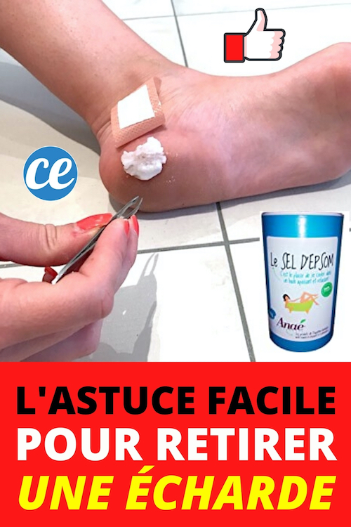Comment Enlever une Écharde Bien Enfoncée Grâce au Sel d