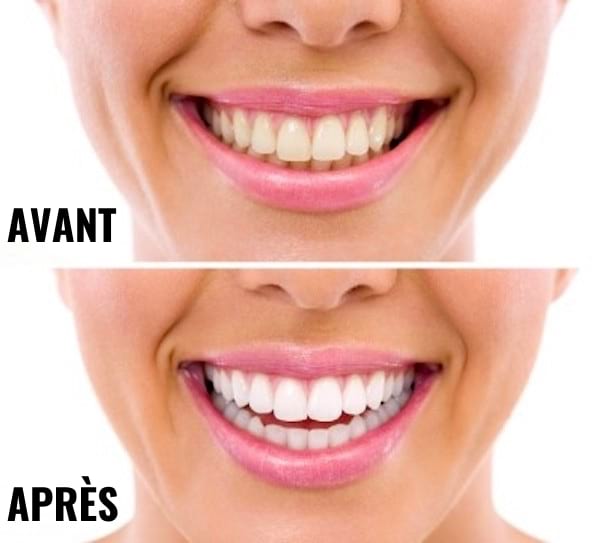 Des dents avant et après un blanchiment avec de l'eau oxygénée.