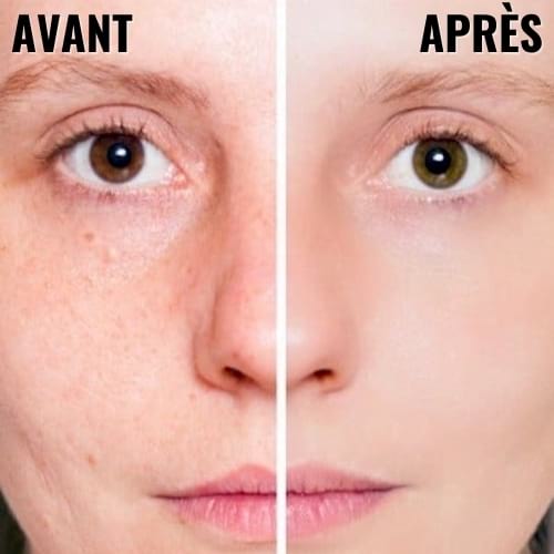 Un visage de femme avant et après un soin à l'eau oxygénée pour faire disparaître les boutons d'acné.