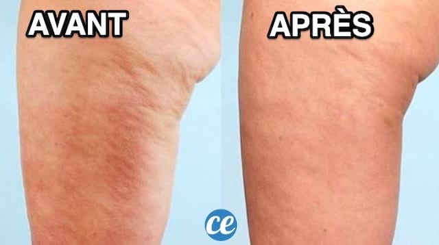 Ma Recette De Grand Mère Contre La Cellulite Qui Marche Vraiment