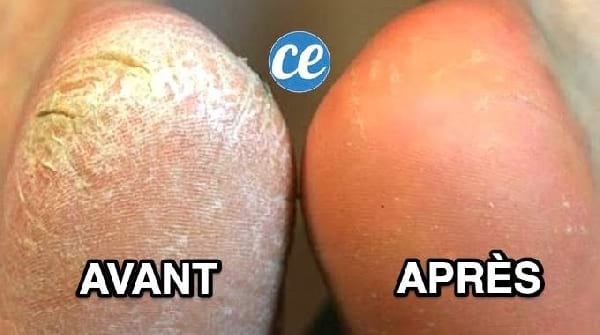 Pieds Secs ? Le Remède Magique Pour Avoir Des Pieds Tout Doux