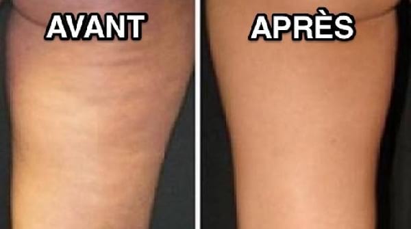 remède efficace anti-cellulite avant après