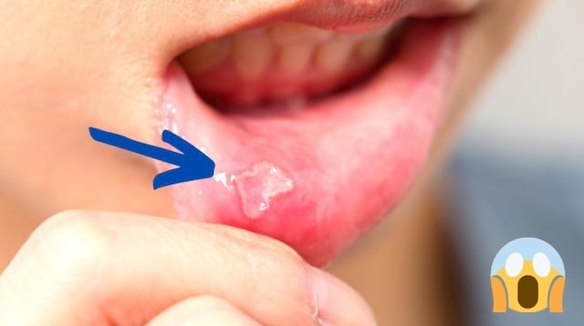 Un aphte à l'intérieur de la lèvre soigné par du vinaigre de cidre