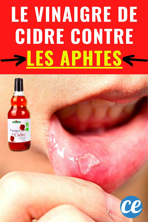 2 Remèdes au Vinaigre de Cidre Contre les Aphtes et Gingivites.