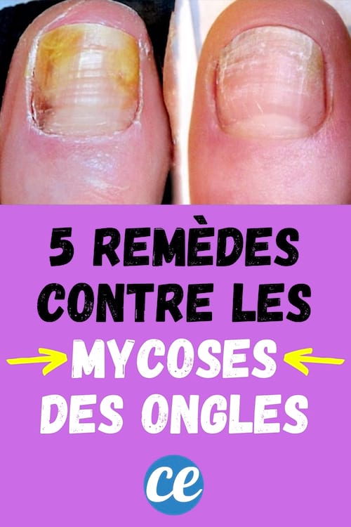 Mycoses des Ongles : Mes 5 Remèdes Naturels Pour en Venir à Bout.