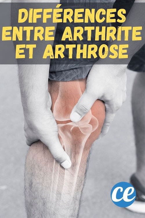 Les différences entre arthrite et arthroses